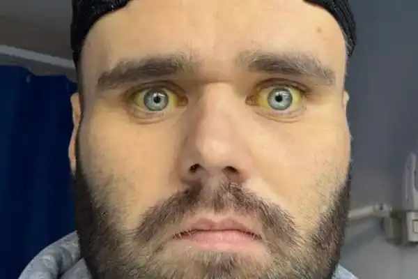 Homem que bebia seis garrafas de vinho por dia relata o terrível impacto na saúde