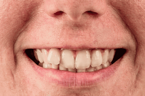 No Japão, yaeba valoriza caninos levemente desalinhados para um sorriso juvenil ‘kawaii’