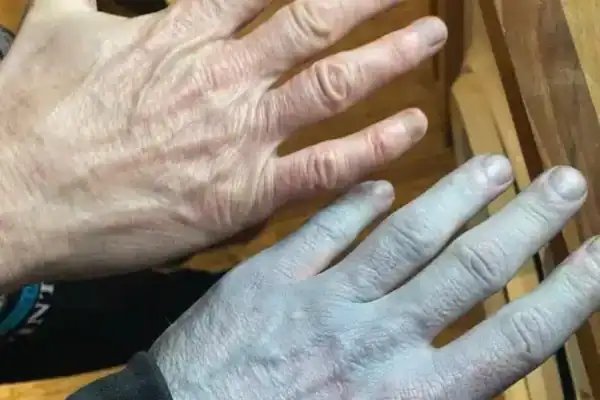 Tommy Lynch é levado às pressas ao Queen’s Hospital após acordar com a pele azul