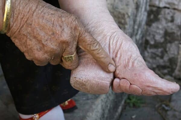 Pé de Lótus: Milhões de meninas tiveram os pés esmagados por tradição da China