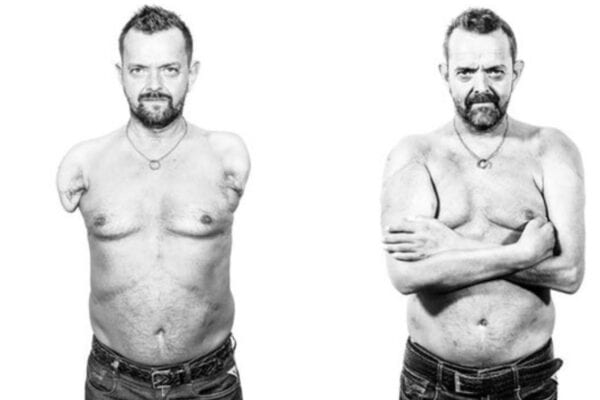 Avanço! Islandês recebe o primeiro transplante duplo de braços e ombros do mundo