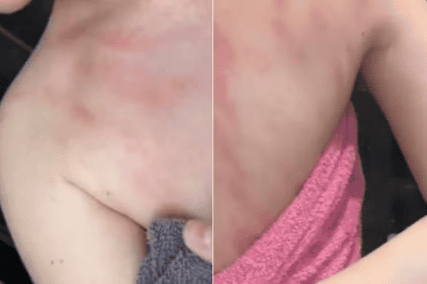 Mulher alérgica à água diz sentir dores intensas ao tomar banho