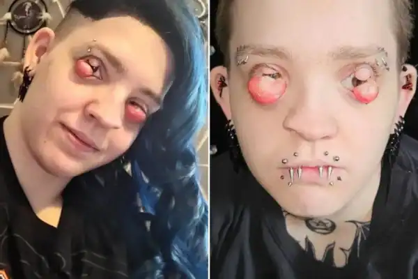 Mulher perde parte da visão por doença ocular congênita rara e busca cirurgia