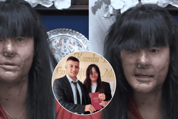 Jovem que teve rosto desfigurado por ácido se casa com agressor após ele deixar a prisão