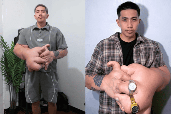 Homem nasce com síndrome que faz suas mãos crescerem sem controle e hoje elas já estão pesando 9kg cada