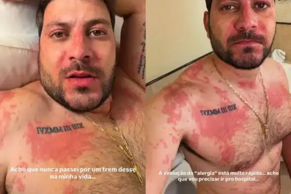 Ex-BBB Caio Afiune atualiza estado de saúde após grave reação alérgica