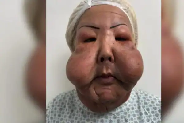 Veja como está Juju do Pix seis meses depois de cirurgia facial
