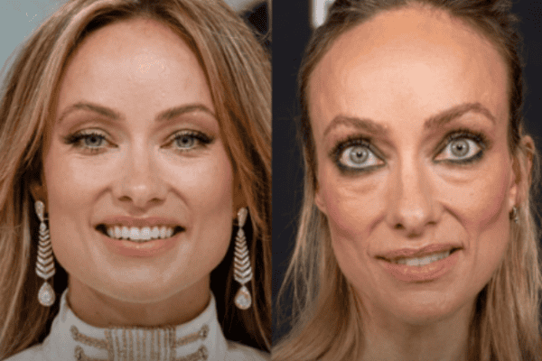 Ozempic? A aparência chocante de celebridades que emagreceram rapidamente