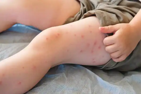 SP registra mais 2 casos de sarampo e total no Estado atinge 30
