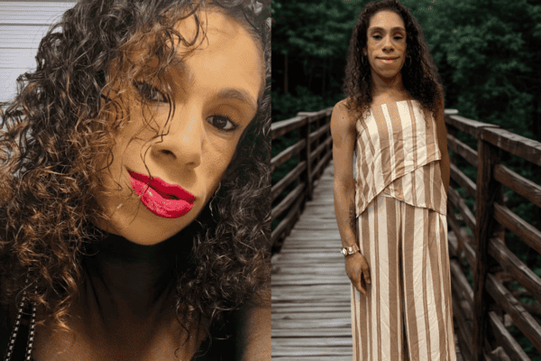 Doença rara faz mulher ter ausência quase total de gordura aparente